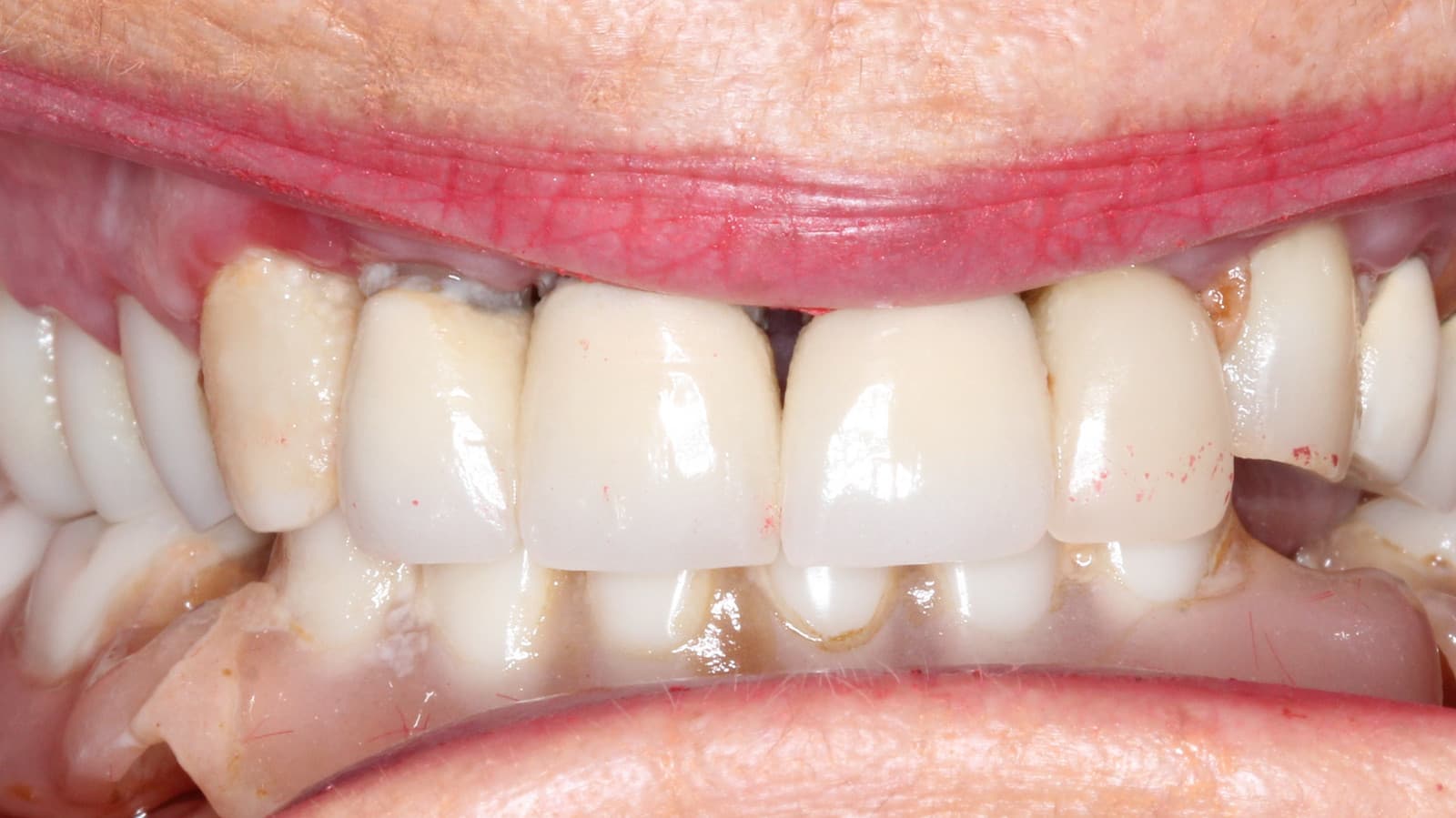Close-up of teeth and gums before treatment at SoCal Prime Dentistry.