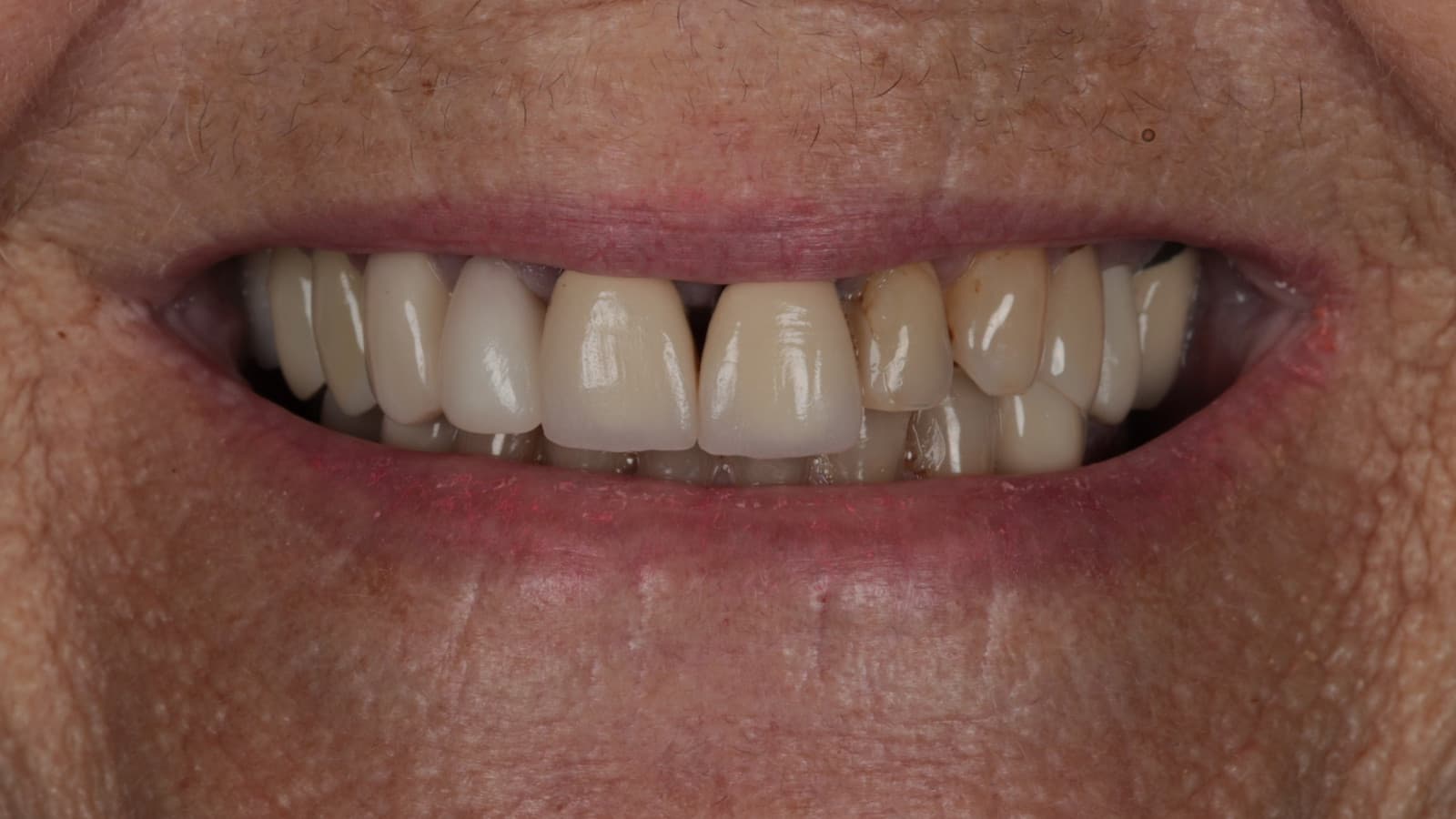 Close-up of a smile before cosmetic dentistry at SoCal Prime Dentistry.