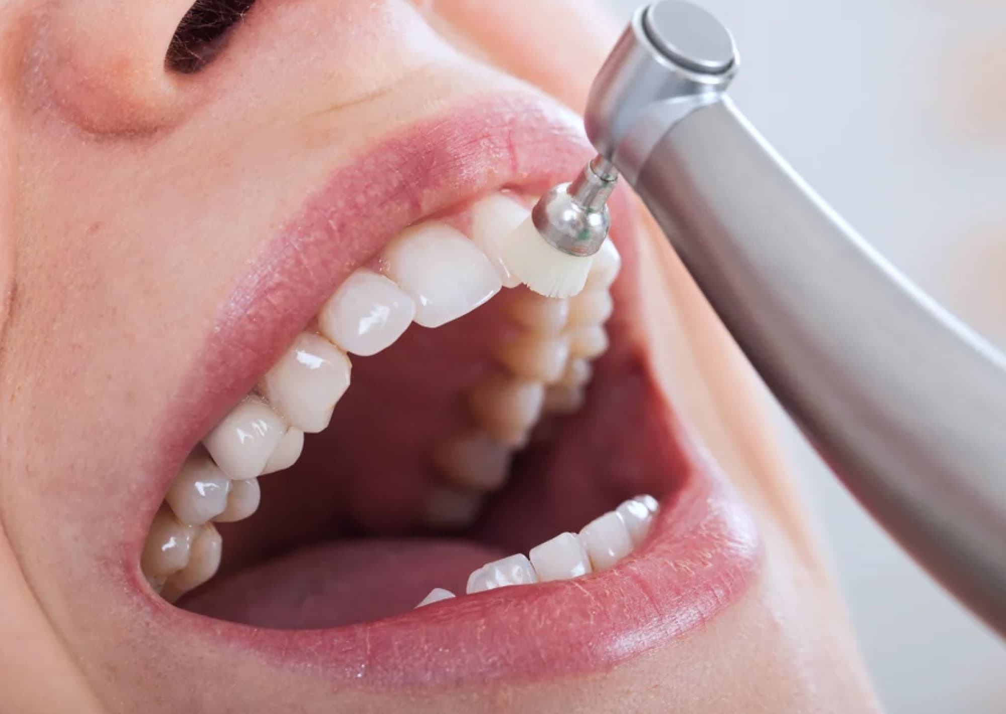 Close-up of a dental cleaning procedure, showcasing a dental hygienist using a polishing tool on a patient's teeth, emphasizing oral hygiene and deep teeth cleaning services.