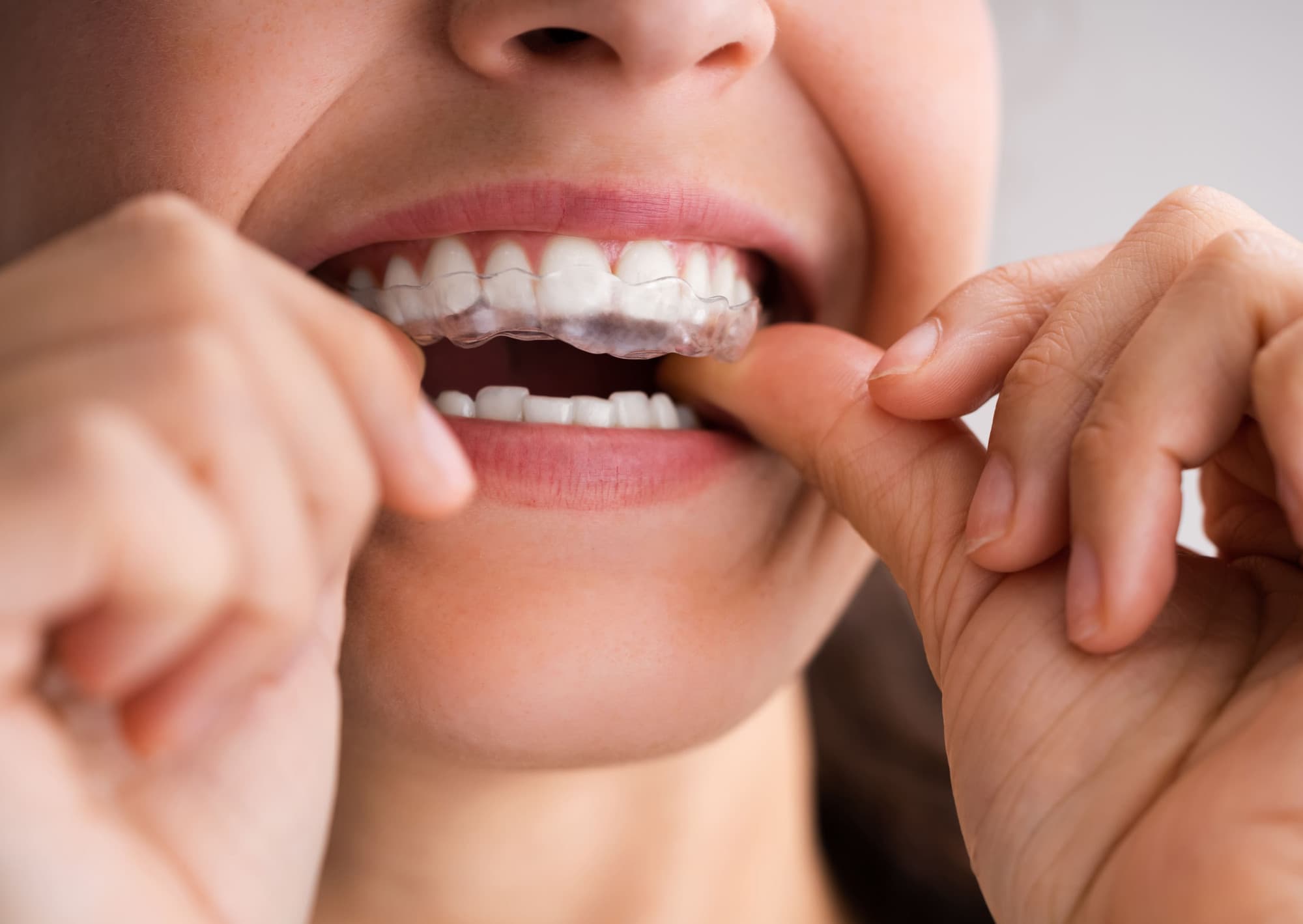 Person inserting custom clear retainer into mouth, demonstrating orthodontic appliance usage for maintaining teeth alignment after braces.